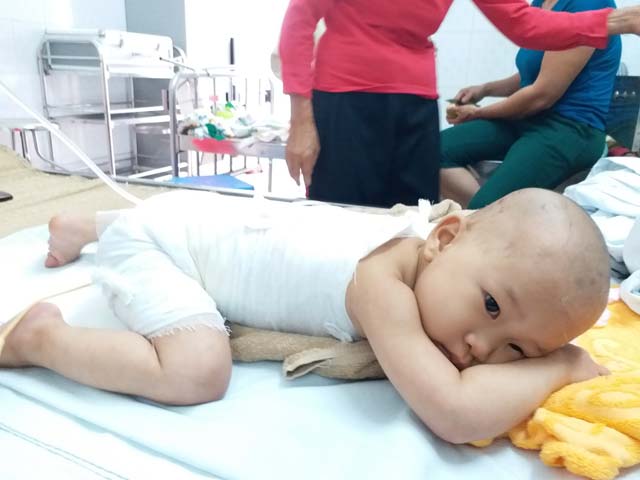 Một em bé ở Điện Biên bị bỏng 40% vì điện giật