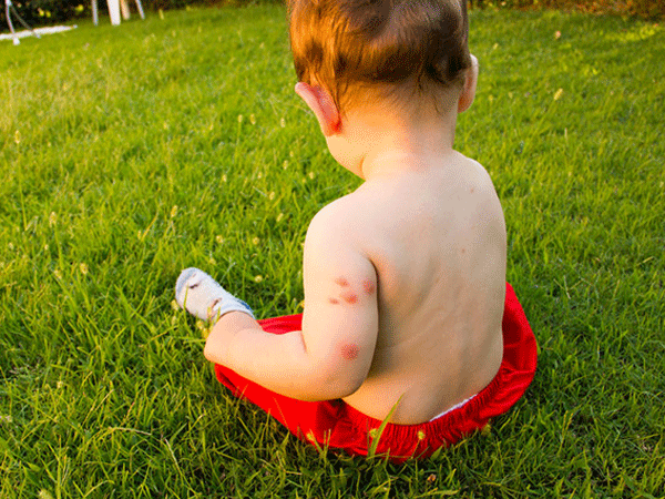 Cách trị muỗi đốt không sưng tấy, hết hẳn sẹo cho bé