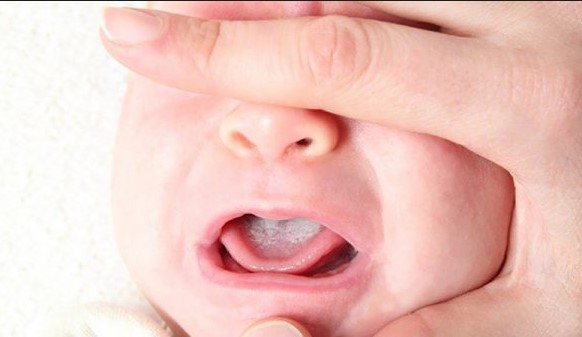 Rơ lưỡi cho trẻ sơ sinh thế nào mới chuẩn?