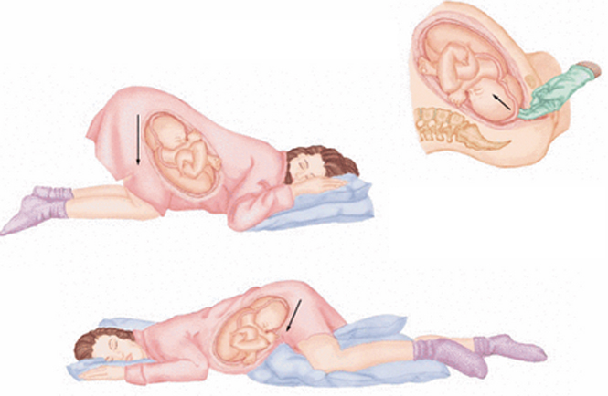 Sa dây rốn khi mang thai: Hiểm nguy rình rập