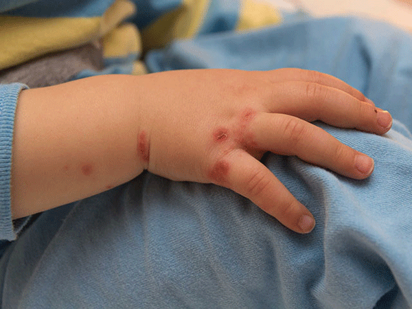 6 yêu cần "khẩn" từ Bộ Y tế để tránh trẻ tử vong do tay chân miệng