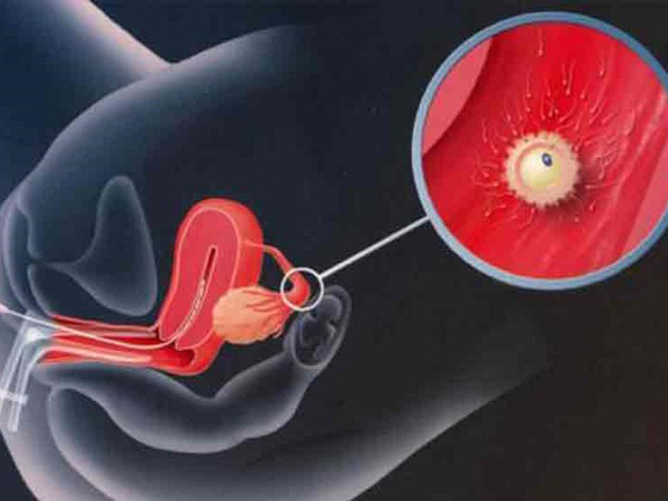Tất tần tật về căn bệnh u bì buồng trứng