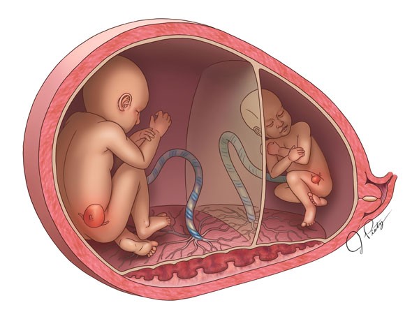 Truyền máu song thai - Bệnh lý hiếm gặp và nguy hiểm trong thai kỳ