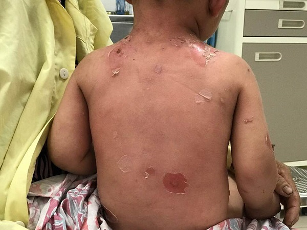 Bé trai 2 tuổi loét toàn thân vì tắm nước lá thuốc