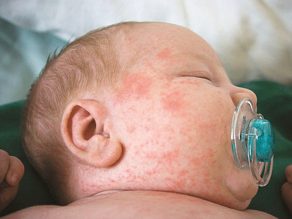 Sởi bùng phát, Bộ Y tế khuyến cáo tiêm vắc xin đủ liều