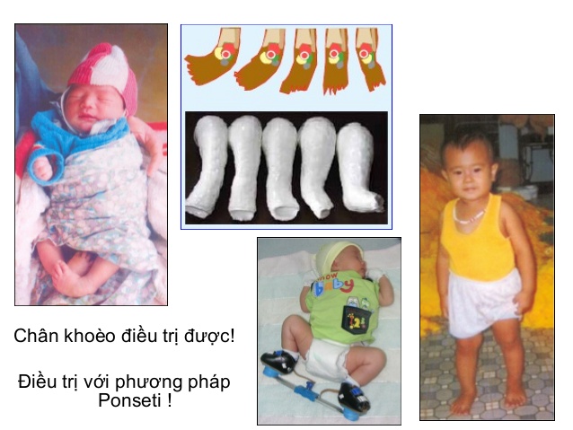 Điều trị thành công một bé trai chân khoèo bẩm sinh ở Nghệ An