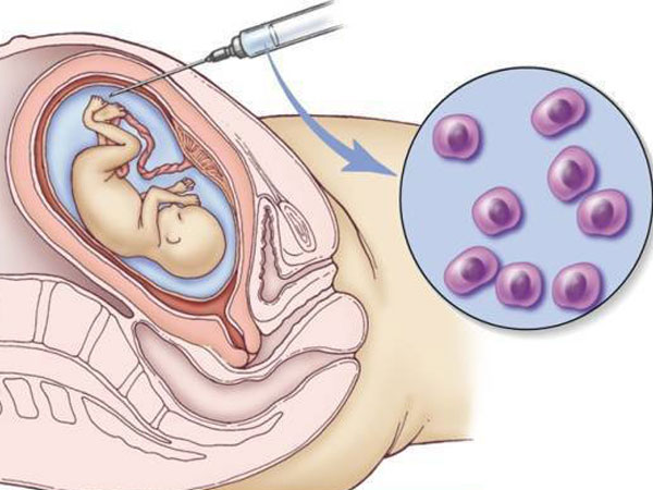 Chọc ối có đau không? Không đáng sợ lắm đâu!