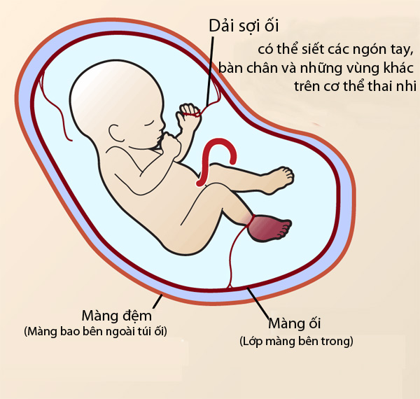 Dải sợi ối - Biến chứng nguy hiểm gây dị tật thai nhi