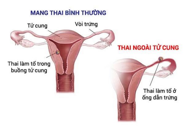 Điều trị bảo tồn vòi trứng khi mang thai ngoài tử cung