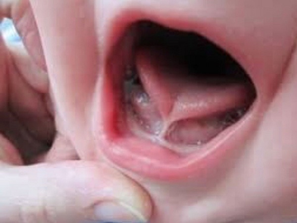 Dấu hiệu nhận biết và cách điều trị dính thắng lưỡi ở trẻ sơ sinh