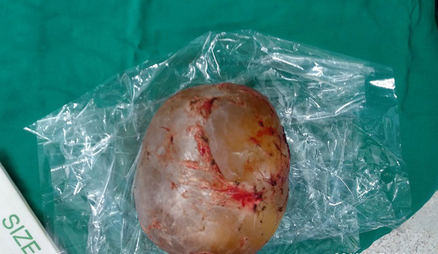 Trà Vinh xuất hiện bé trai mang khối u "thai trong thai" tỷ lệ 1/500.000