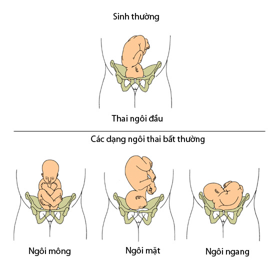 Ngôi thai: Yếu tố quyết định việc sinh nở