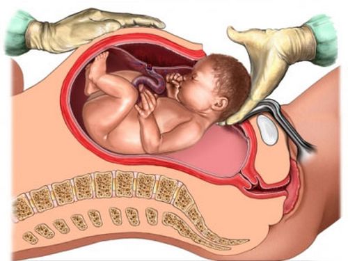 Khi nào mẹ nên sinh mổ?