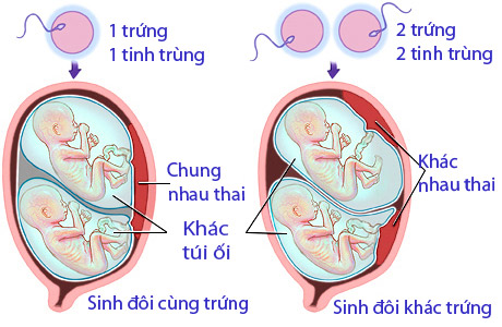 Thai đôi được hình thành như thế nào?