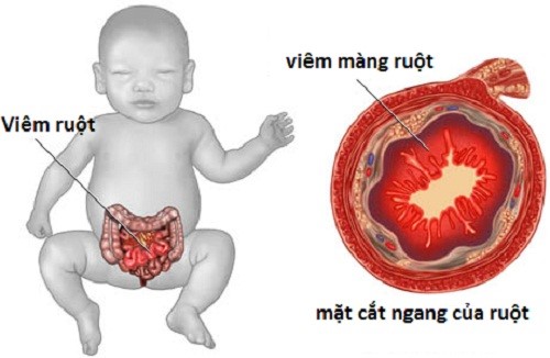 Giải pháp cho trẻ không tăng cân do kém hấp thu