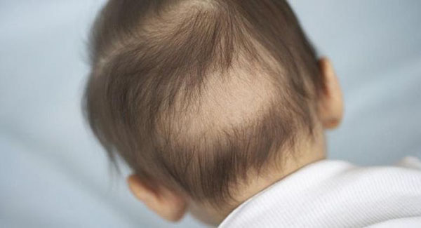 Những hiện tượng trẻ sơ sinh bị rụng tóc mẹ cần biết
