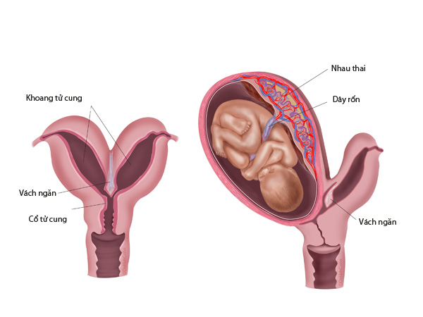 Tử cung có vách ngăn và những khó khăn cho mẹ bầu