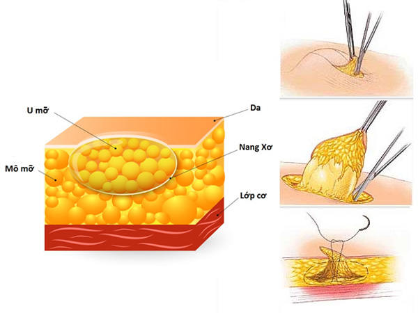 Mẹ bầu bị u mỡ dưới da có đáng ngại?