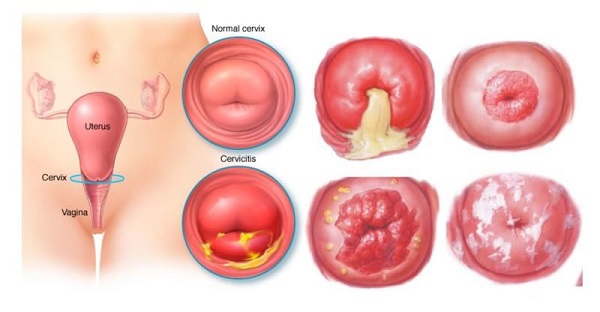 Viêm lộ tuyến tử cung và những điều chị em cần biết